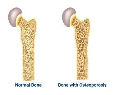 Normal Bone v Bone with Osteoporosis Normal Bone v Bone with Osteoporosis