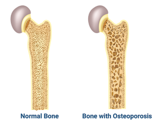 osteoporosis osteoporosis