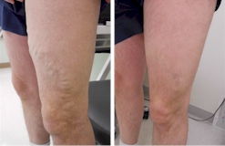 Veins Before and After Procedure