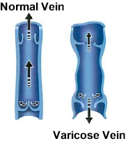 varicose veins