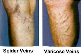 spider and varicose veins